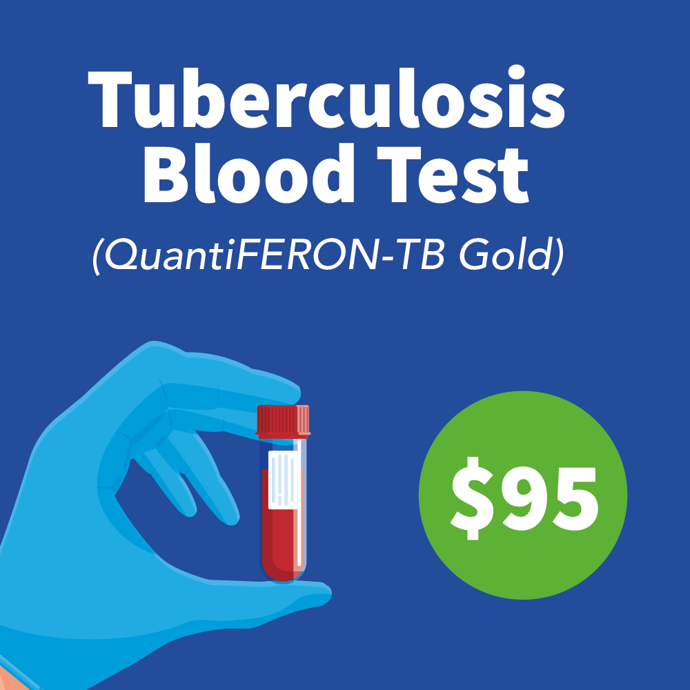 The QuantiFERON-TB Gold test is required for immigrants and refugees in the United States.