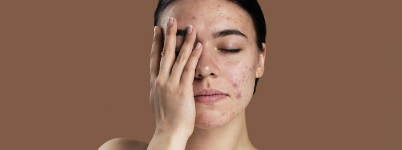 5 consejos efectivos sobre cómo combatir el acné